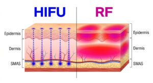 HIFU와 RF 리프팅의 에너지 전달 깊이 비교 다이어그램